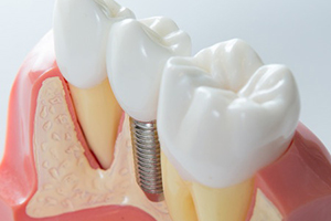 dental-implant